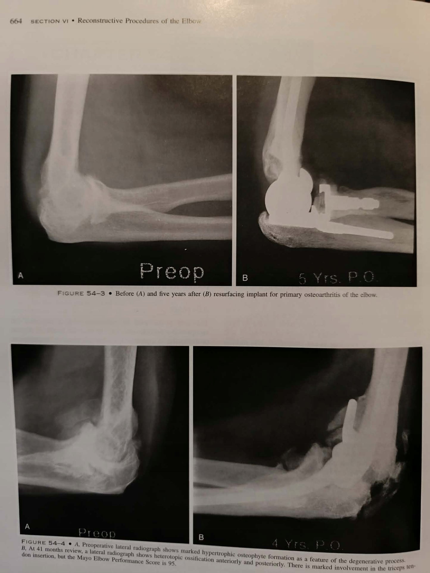 The elbow and its disorders, Morrey, third edition