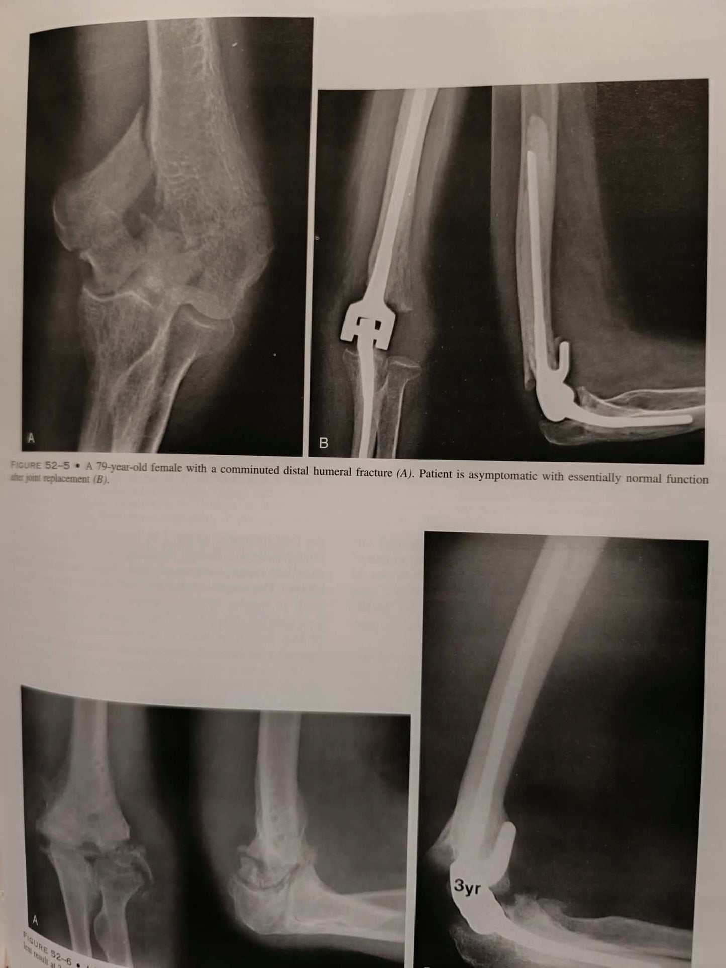 The elbow and its disorders, Morrey, third edition