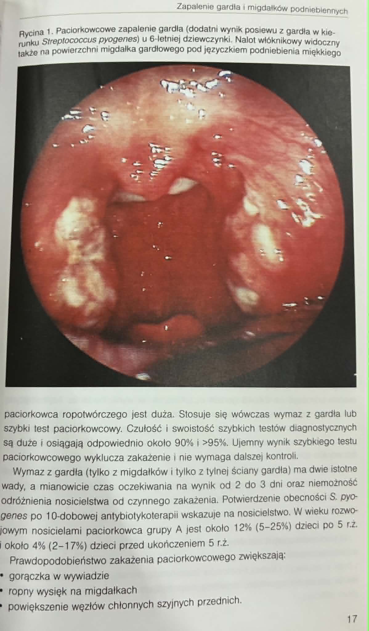 Choroby Laryngologiczne u Dzieci Beata Zielnik-Jurkiewicz